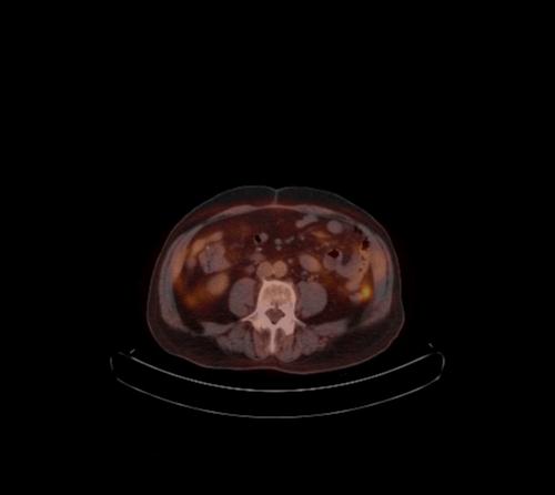 Abdominal wall metastasis from colorectal carcinoma (Radiopaedia 31016-31719 C 56).jpg