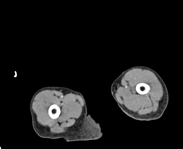 File:Abdominopelvic rhabdomyosarcoma (Radiopaedia 78356-90984 Axial C+ portal venous phase 177).jpg