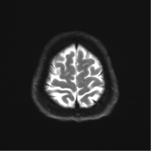 File:Abducens nerve palsy (Radiopaedia 51069-56648 Axial DWI 24).png