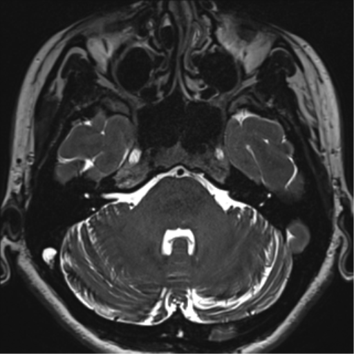 Abducens nerve palsy (Radiopaedia 51069-56648 Axial T2 fat sat 27).png