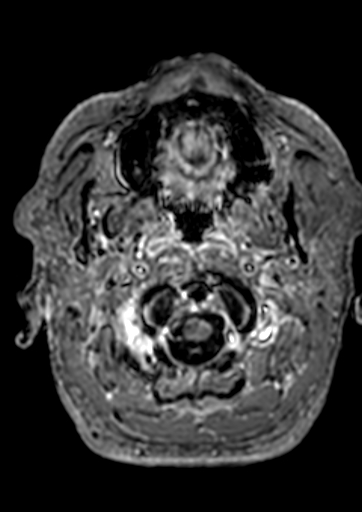 Accessory middle cerebral artery (Radiopaedia 73114-83828 Axial T1 C+ 199).jpg