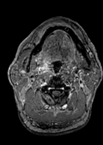 Accessory middle cerebral artery (Radiopaedia 73114-83828 Axial T1 C+ 284).jpg