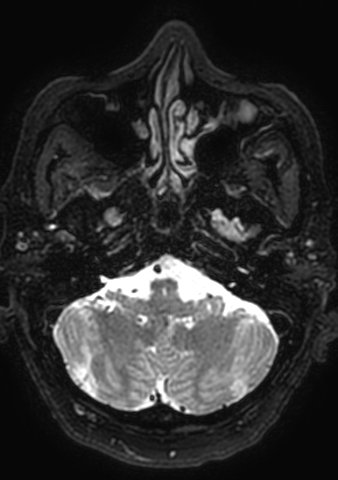 Accessory middle cerebral artery (Radiopaedia 73114-83828 Axial T2 180).jpg