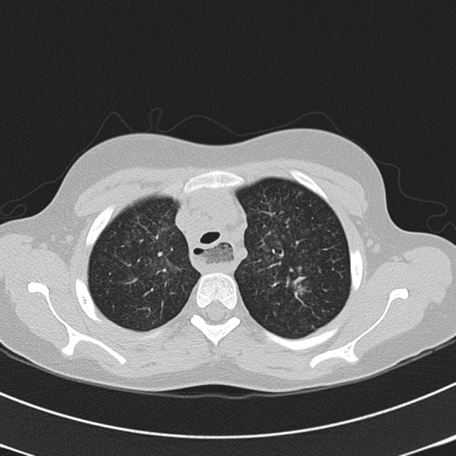 Achalasia (Radiopaedia 14946-14878 Axial lung window 14).jpg