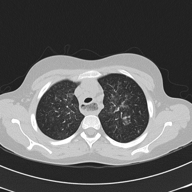Achalasia (Radiopaedia 14946-14878 Axial lung window 15).jpg