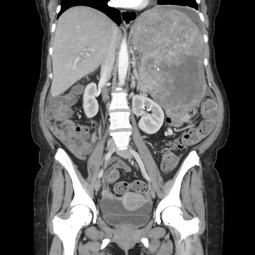 Acinar cell carcinoma of the pancreas (Radiopaedia 75442-86669 Coronal C+ portal venous phase 70).jpg