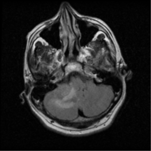 File:Acoustic schwannoma (Radiopaedia 39170-41387 Axial FLAIR 4).png