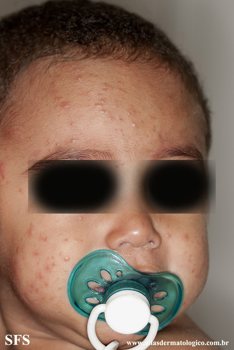 Acrodermatitis Infantile Papular (Dermatology Atlas 31).jpg