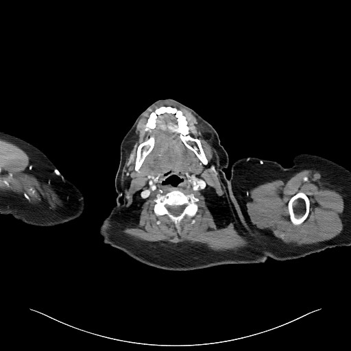 Acromioclavicular joint cyst (Radiopaedia 58455-65610 Axial C+ arterial phase 1).jpg