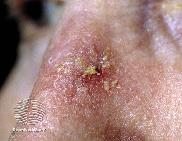 File:Actinic keratoses (DermNet NZ lesions-s-sk3).jpg