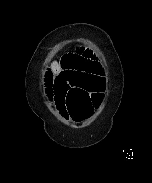 Active Crohn disease (Radiopaedia 59394-66750 Coronal C+ portal venous phase 10).jpg