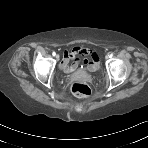 Active bleeding from duodenal ulcer with embolization (Radiopaedia 34216-35481 C 61).png