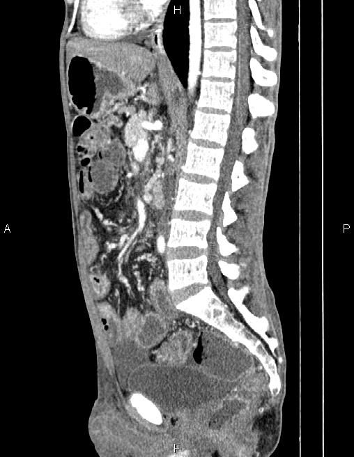 Active crohn disease (Radiopaedia 87133-103397 Sagittal C+ arterial phase 45).jpg