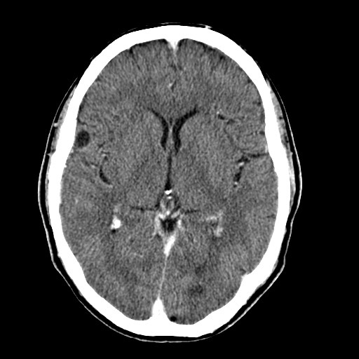 File:Active neurocysticercosis before and after therapy (Radiopaedia 71710-82099 Axial C+ delayed 52).jpg
