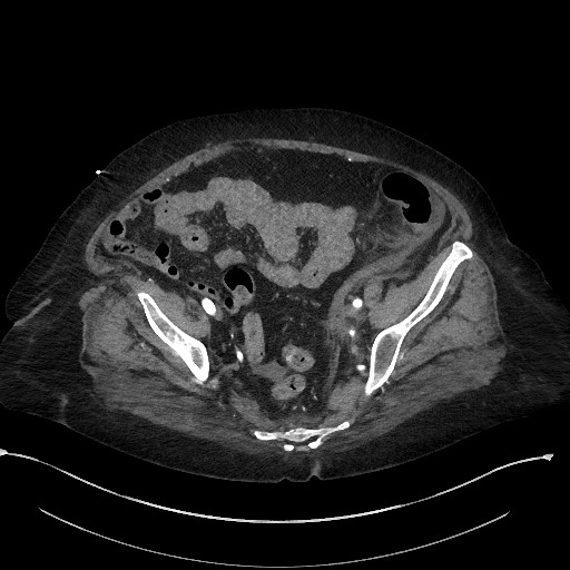 File:Active renal extravasation with large subcapsular and retroperitoneal hemorrhage (Radiopaedia 60975-68796 Axial C+ arterial phase 157).jpg