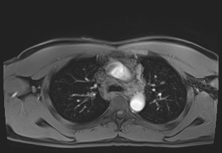 File:Active right ventricular cardiac sarcoidosis (Radiopaedia 55596-62100 Axial Post contrast Dixon 17).jpg