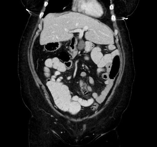 Acute appendicitis, heterotaxy syndrome (Radiopaedia 66884-76202 Coronal C+ portal venous phase 35).jpg
