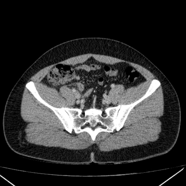 File:Acute appendicitis (Radiopaedia 38255-40270 Axial C+ portal venous phase 84).jpg