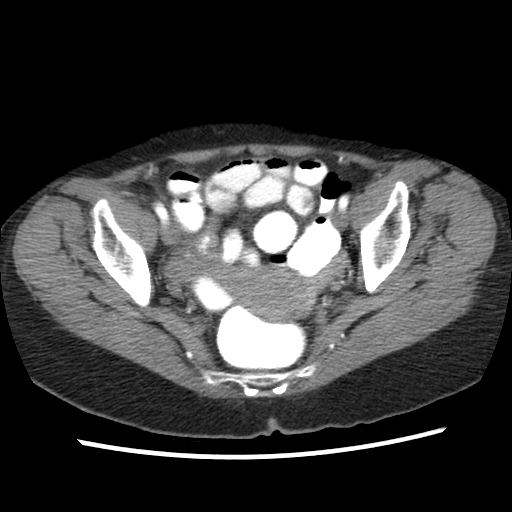 File:Acute appendicitis (Radiopaedia 52672-58589 Axial 16).jpg