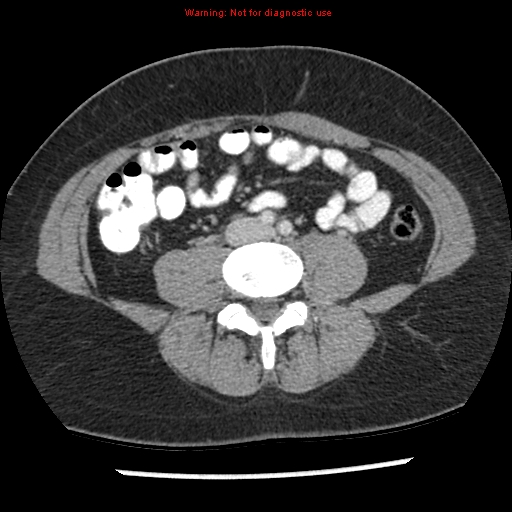 File:Acute appendicitis (Radiopaedia 7966-8812 C+ portal venous phase 30).jpg