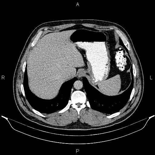 File:Acute appendicitis (Radiopaedia 84780-100240 Axial C+ portal venous phase 18).jpg