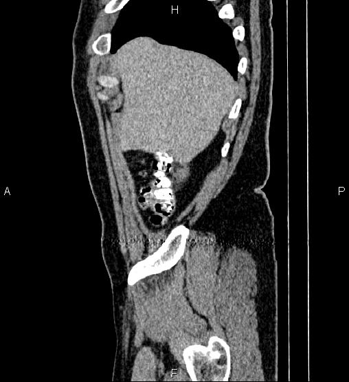 Acute appendicitis (Radiopaedia 84780-100240 Sagittal C+ portal venous phase 10).jpg