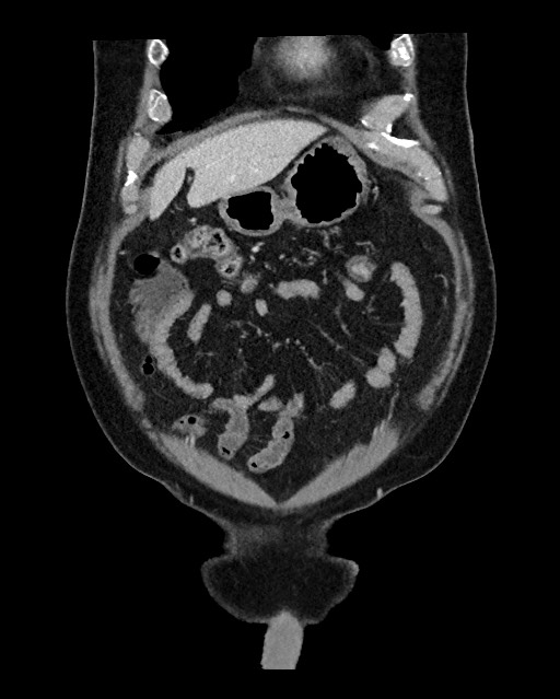 Acute appendicitis - large appendicoliths (Radiopaedia 61805-69820 Coronal C+ portal venous phase 31).jpg