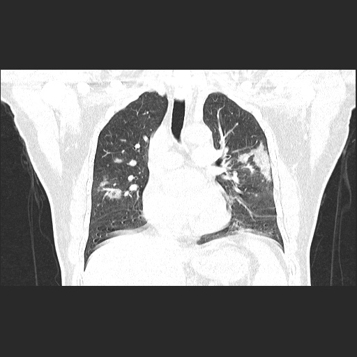 Acute appendicitis and COVID 19 pneumonia (Radiopaedia 76604-88380 G 32).jpg