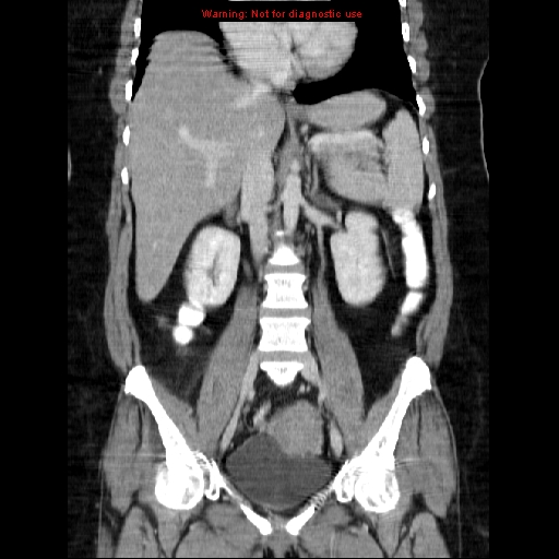 File:Acute appendicitis complicated by ovarian vein thrombophlebitis (Radiopaedia 16172-15851 Coronal C+ portal venous phase 45).jpg