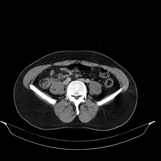 File:Acute appendicitis with appendicoliths (Radiopaedia 21148-21062 Axial C+ portal venous phase 9).jpg