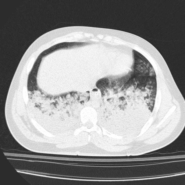 Acute aspiration pneumonitis (Radiopaedia 33605-34703 Axial lung window 71).jpg
