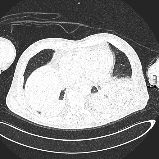 Acute aspiration pneumonitis (Radiopaedia 55642-62166 Axial lung window 118).jpg