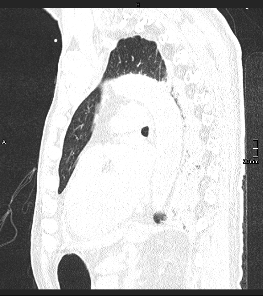 File:Acute aspiration pneumonitis (Radiopaedia 55642-62166 Sagittal lung window 57).jpg