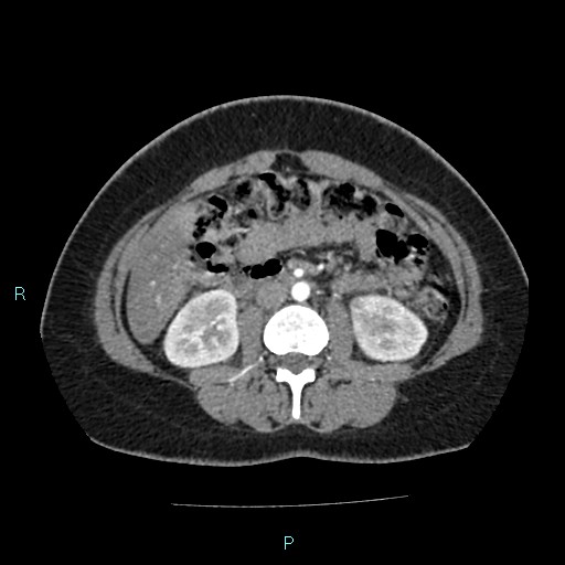 Acute bilateral pyelonephritis (Radiopaedia 37146-38881 Axial C+ arterial phase 94).jpg