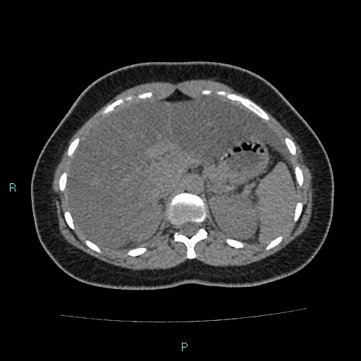 Acute bilateral pyelonephritis (Radiopaedia 37146-38881 Axial non-contrast 28).jpg