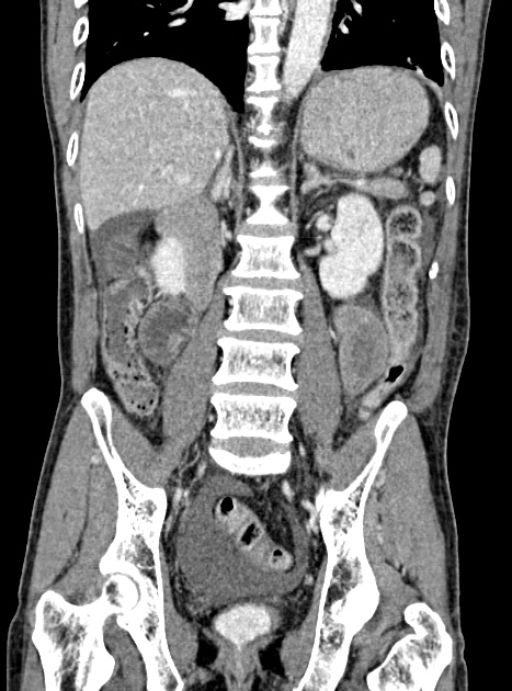 Acute bowel ischemia (Radiopaedia 87695-104114 Coronal C+ portal venous phase 244).jpg