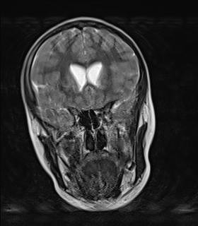 File:Acute cerebellar ataxia (Radiopaedia 61487-69446 Coronal T2 3).jpg