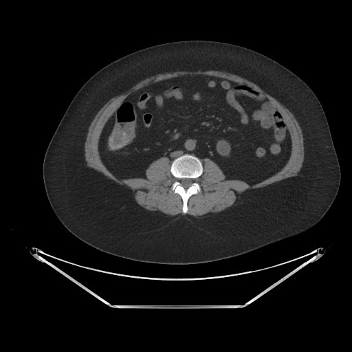 File:Acute cholecystitis with tensile fundus sign (Radiopaedia 71394-81723 Axial non-contrast 57).jpg