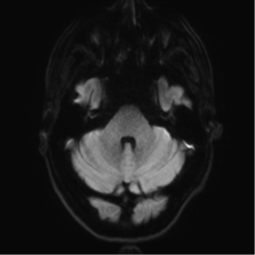 File:Acute disseminated encephalomyelitis (ADEM) (Radiopaedia 65319-74350 Axial DWI 6).png