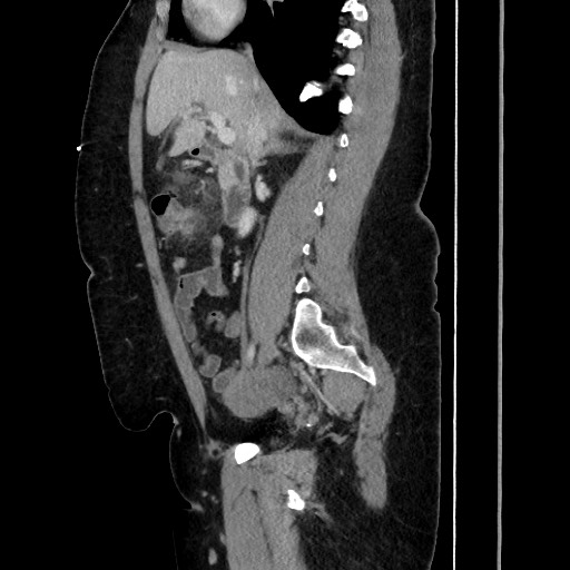 Acute diverticulitis - transverse colon (Radiopaedia 87063-103327 Sagittal C+ portal venous phase 103).jpg