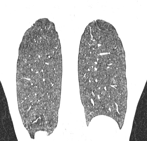 Acute hypersensitivity pneumonitis (Radiopaedia 85293-100870 Coronal lung window 111).jpg