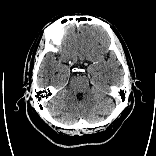 Acute left middle cerebral artery territory ischemic stroke (Radiopaedia 35688-37223 Axial non-contrast 23).png