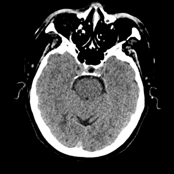 Acute middle cerebral artery territory infarct (Radiopaedia 52380-58283 Axial non-contrast 31).jpg