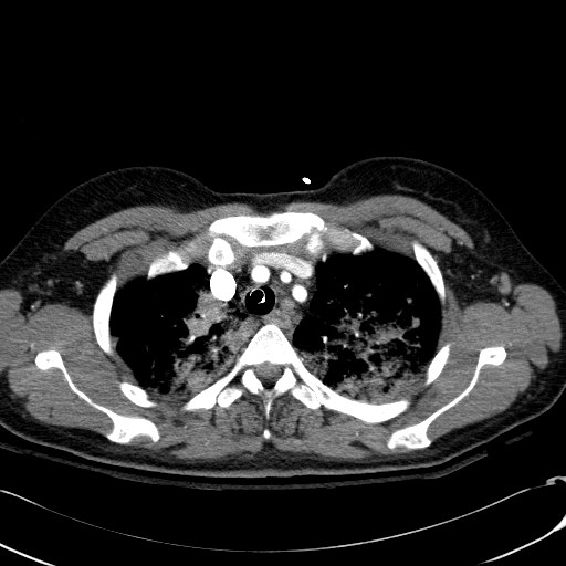 File:Acute myocardial infarction in CT (Radiopaedia 39947-42415 Axial C+ arterial phase 28).jpg