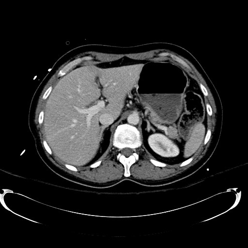 File:Acute myocardial infarction in CT (Radiopaedia 39947-42415 Axial C+ portal venous phase 34).jpg