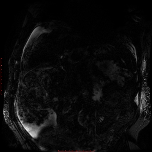 Acute necrotizing pancreatitis (Radiopaedia 28194-28448 Coronal MRCP 50).jpg