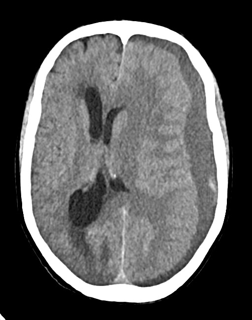 Acute on chronic subdural hematoma (Radiopaedia 74814-85823 Axial non-contrast 48).jpg