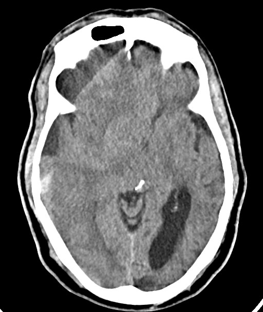 Acute on chronic subdural hematoma (Radiopaedia 78346-90966 Axial non-contrast 30).jpg