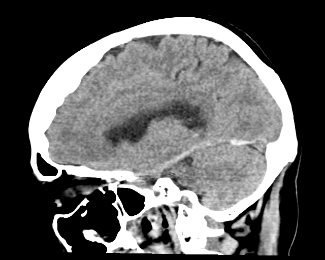 Acute on chronic subdural hemorrhage (Radiopaedia 85330-100923 Sagittal non-contrast 31).jpg