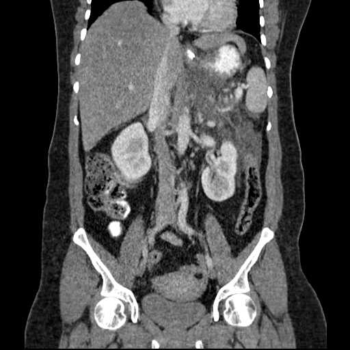 File:Acute pancreatitis (Radiopaedia 20829-20744 Coronal C+ portal venous phase 31).jpg